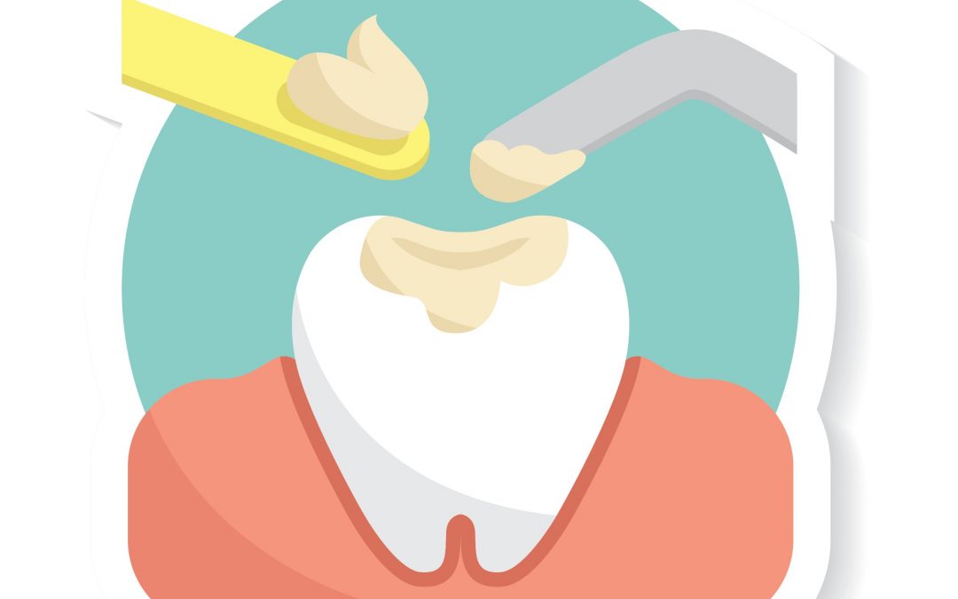 What Is a Dental Amalgam Filling?