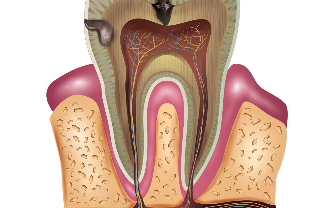 What Is a Root Canal?