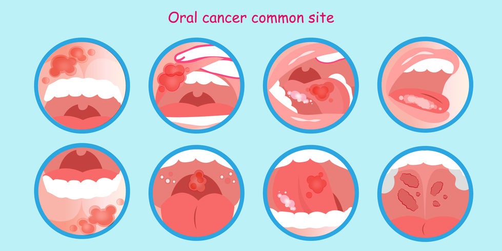 8 Tips to Prevent Oral Cancer