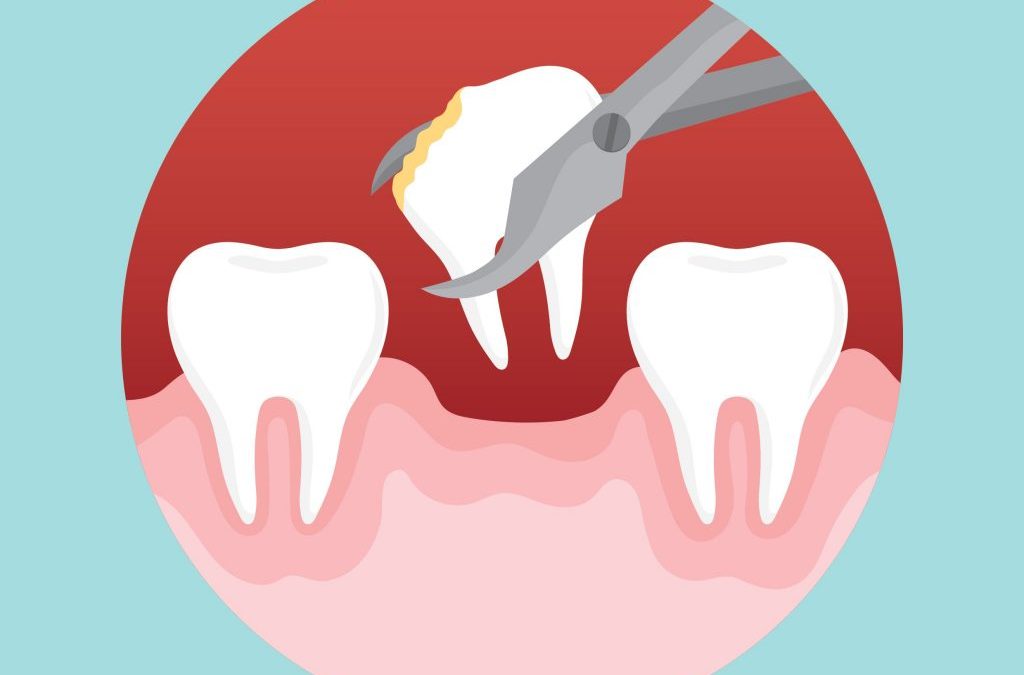 5 Reasons You May Need a Tooth Extraction