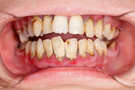What Causes Cavities (and How to Avoid Getting Them)?