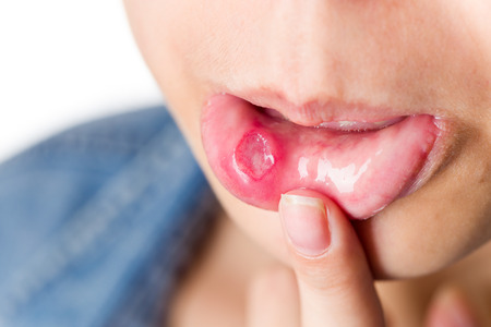 4 Common Causes of Canker Sores