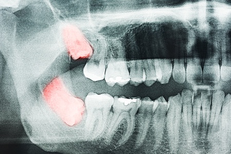 Recovery Tips after Wisdom Teeth Removal