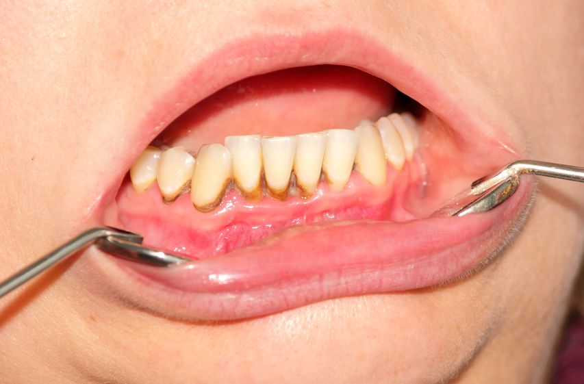 Prevent Gum Disease with Smile Savings Plan