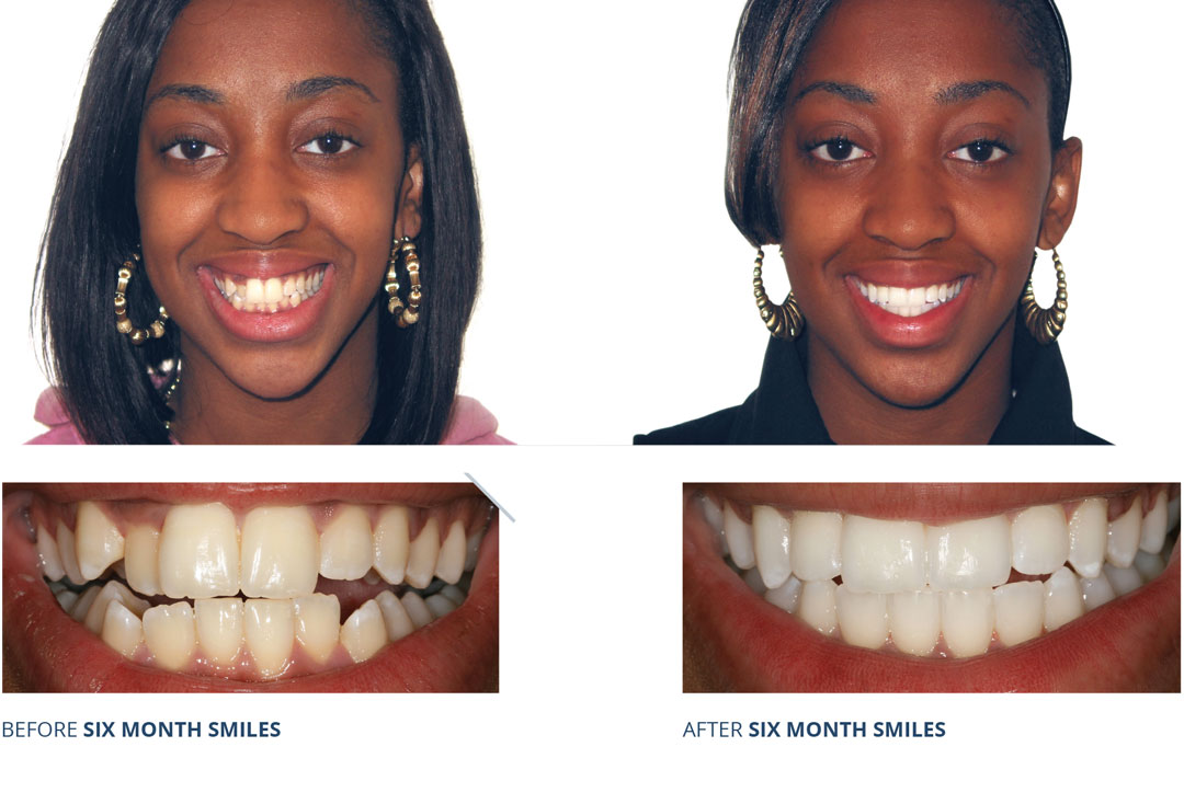 before and after six month smiles