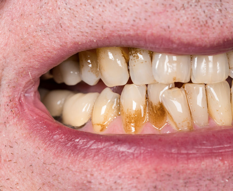 Receding gums need special care.