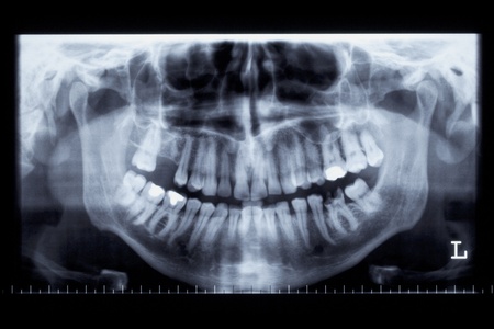 Dental x-rays illuminate oral health!