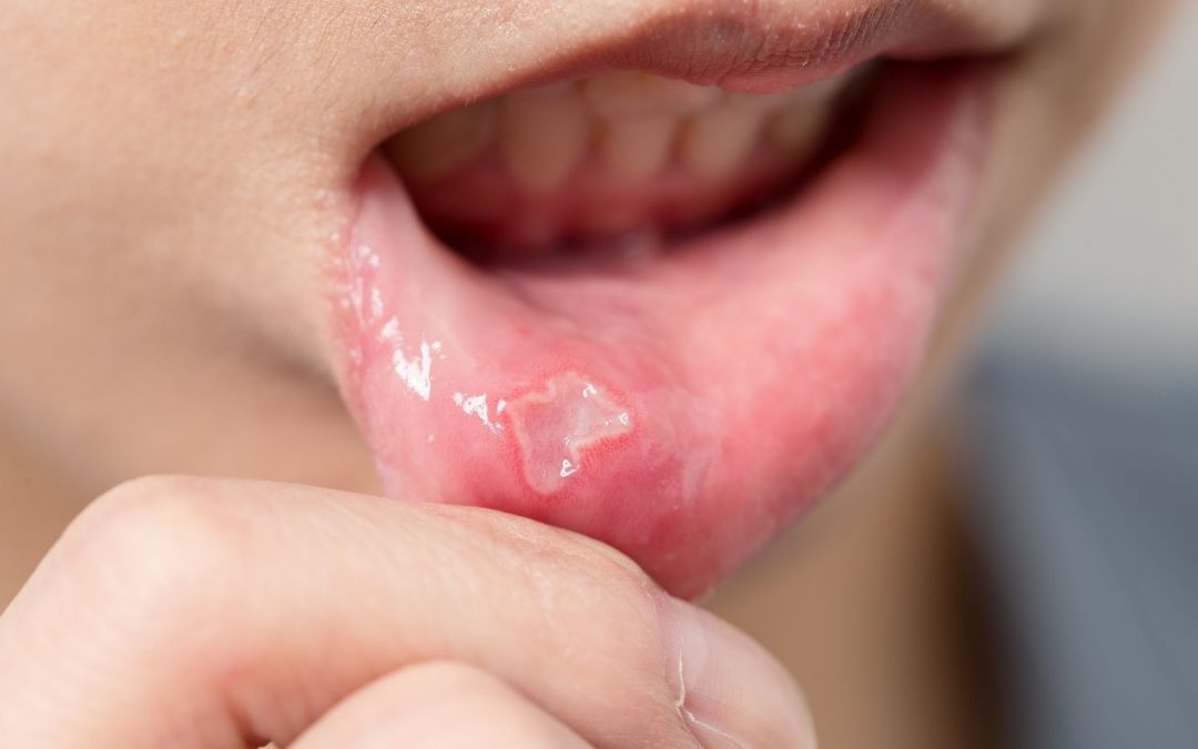 Oral Lesions are bothersome and can hurt.