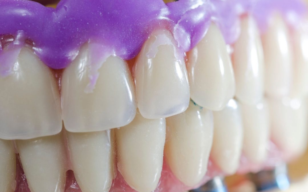Dental veneers are not just for looks