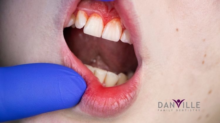 Deep cleaning is the best treatment for periodontal disease.