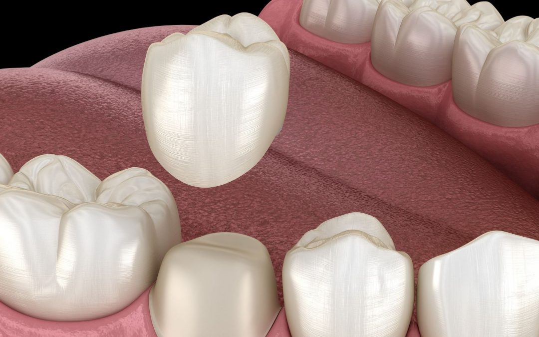 A dental crown protects a tooth from decay and more.