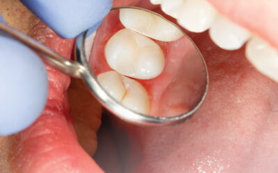 Dental Sealants Are a Reliable Preventative Measure